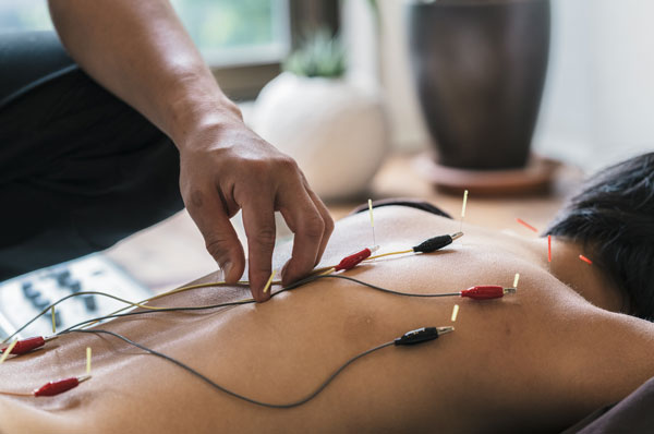 Acupuncture-Electroacupuncture